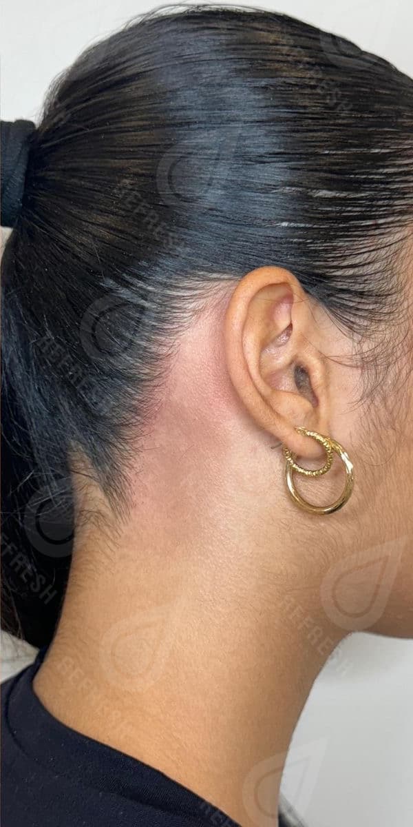 Laser hair removal with Candela GentleMax Pro