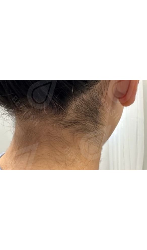 Laser hair removal with Candela GentleMax Pro