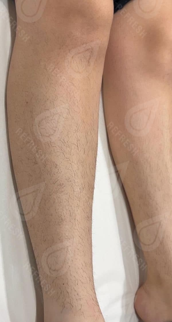 Laser hair removal with Candela GentleMax Pro