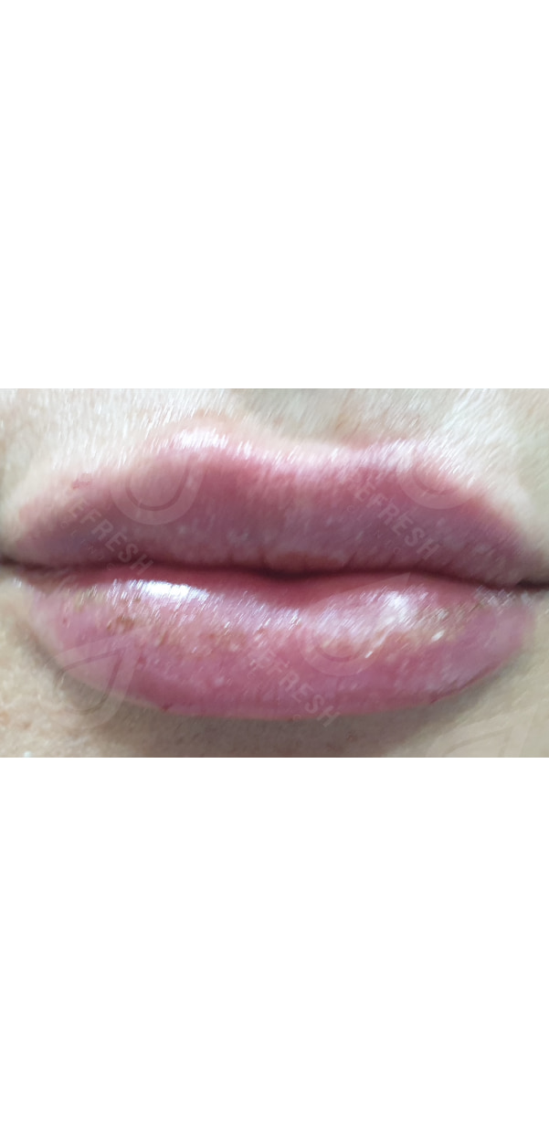 Facial Contouring with Dermal Fillers