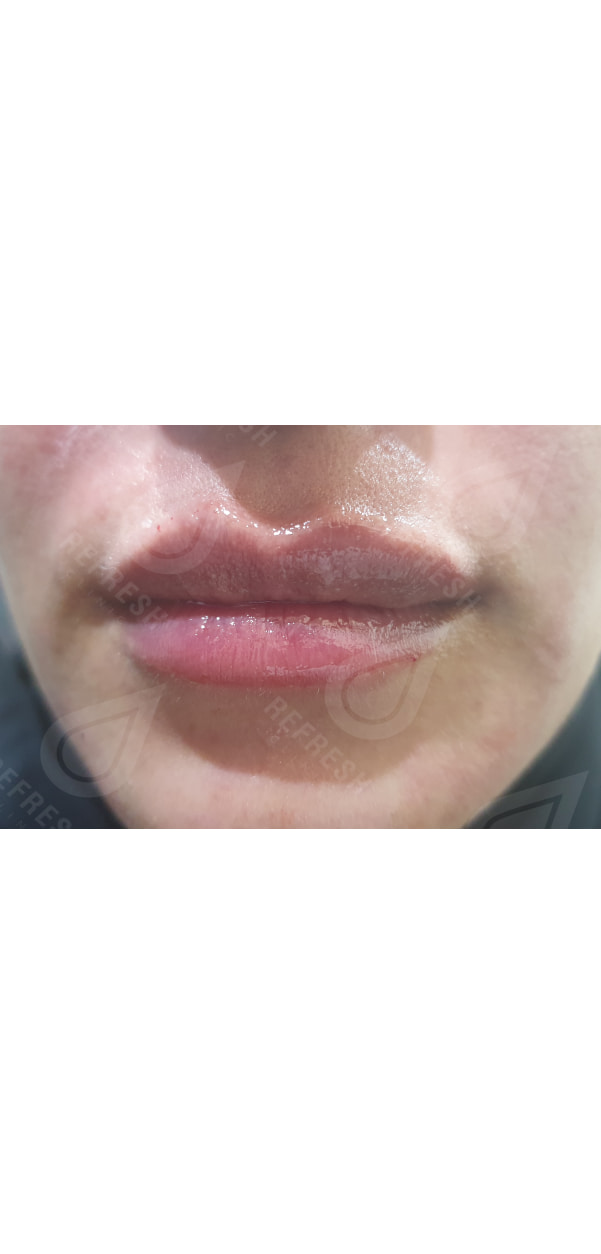 Facial Contouring with Dermal Fillers