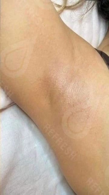 Laser hair removal with Candela GentleMax Pro