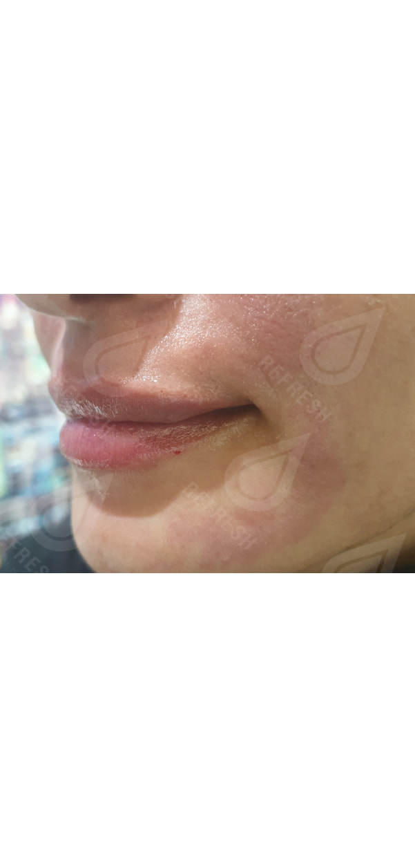 Facial Contouring with Dermal Fillers