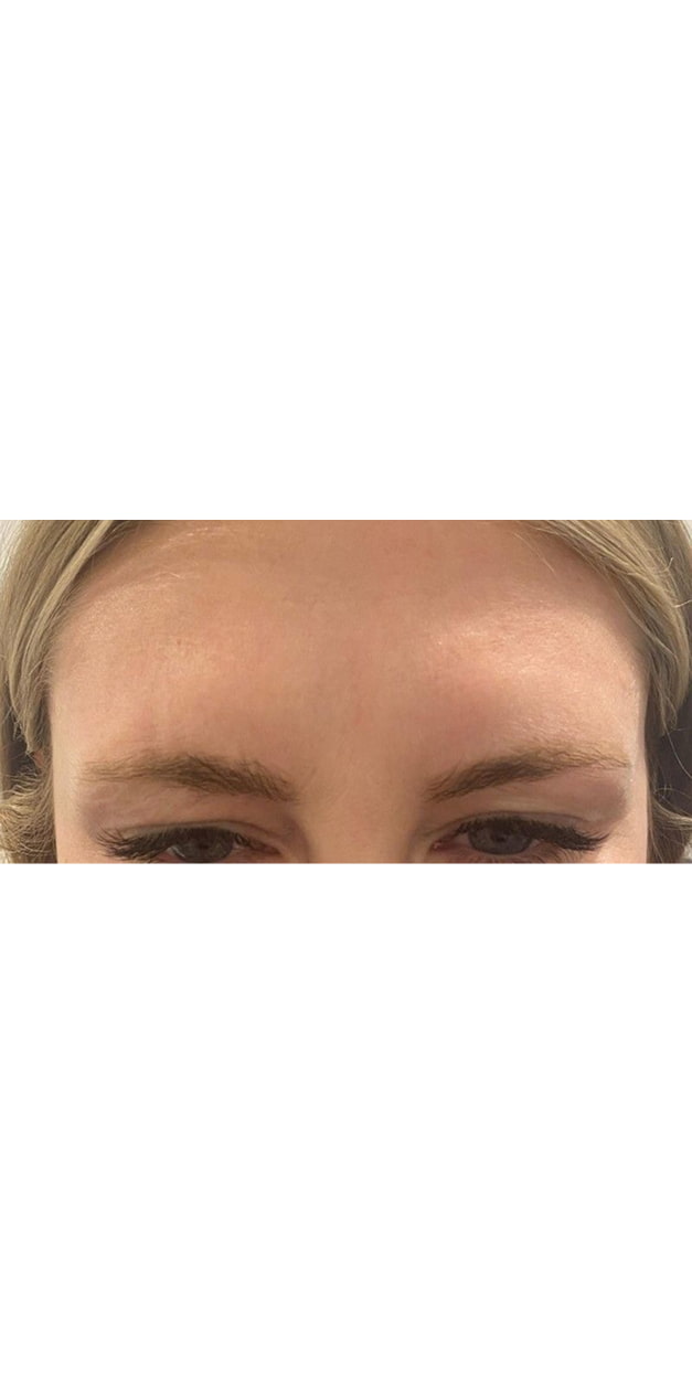 Botulinum Toxin Treatment