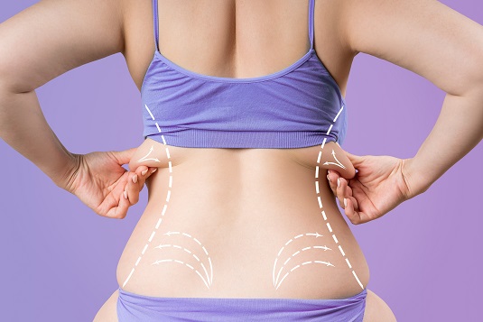 Stubborn fat pockets that don’t respond to diet and how lipolysis helps reduce them