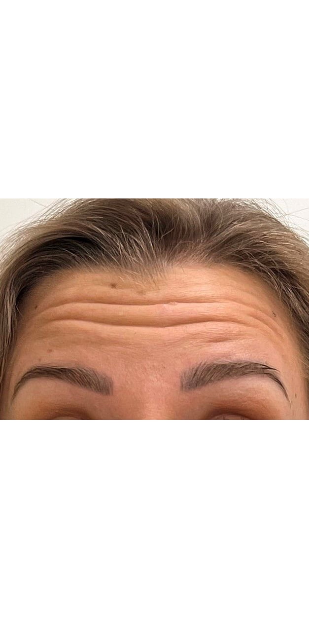 Botulinum Toxin Treatment