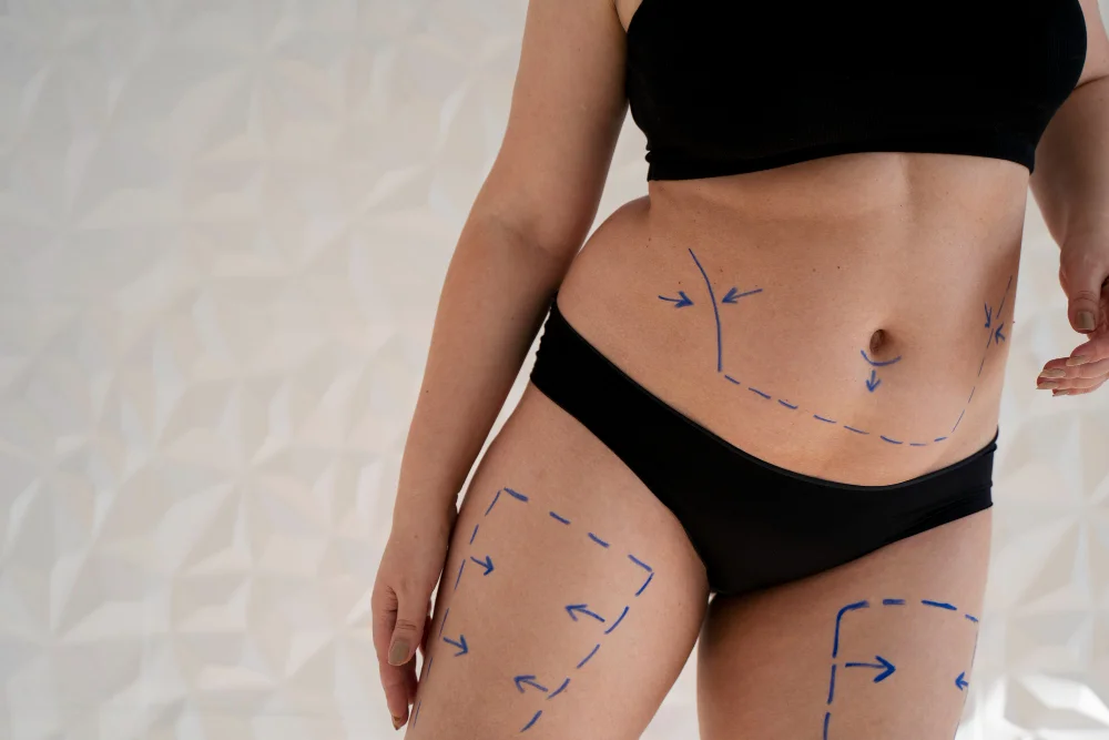 Stubborn fat pockets that don’t respond to diet and how lipolysis helps reduce them