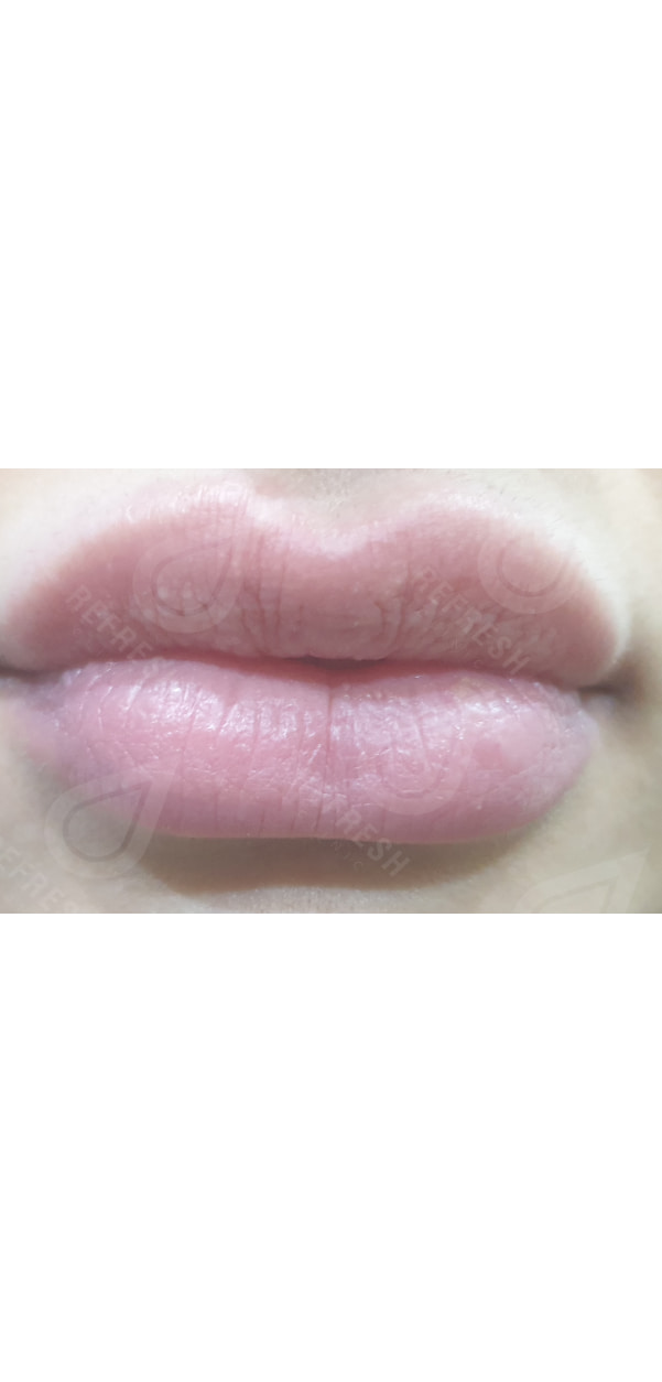 Facial Contouring with Dermal Fillers
