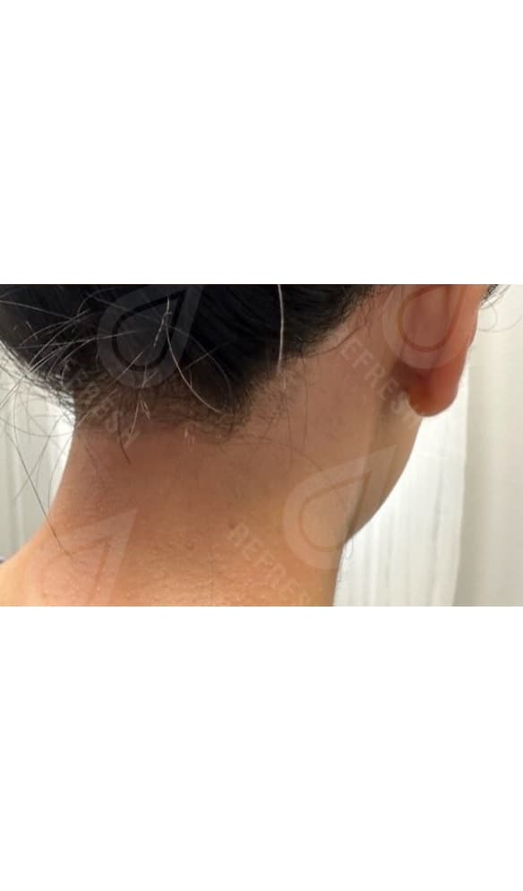 Laser hair removal with Candela GentleMax Pro