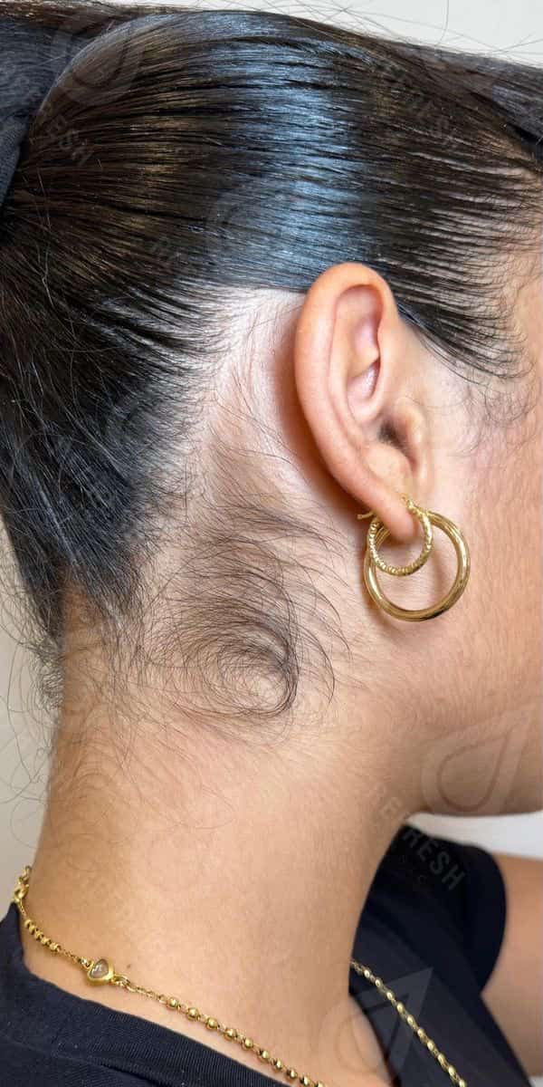 Laser hair removal with Candela GentleMax Pro