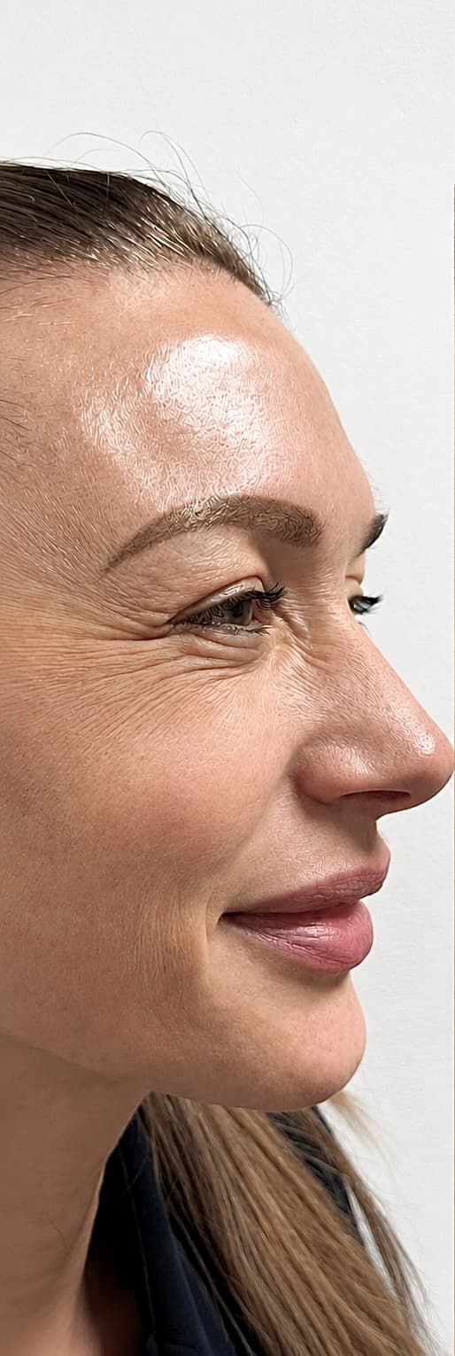 Botulinum Toxin Treatment