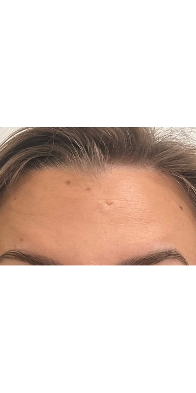 Botulinum Toxin Treatment