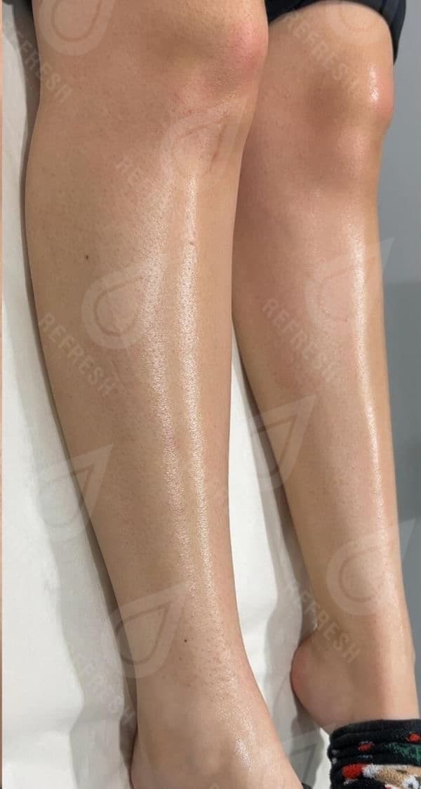 Laser hair removal with Candela GentleMax Pro