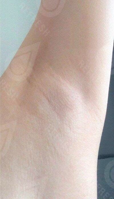Laser hair removal with Candela GentleMax Pro