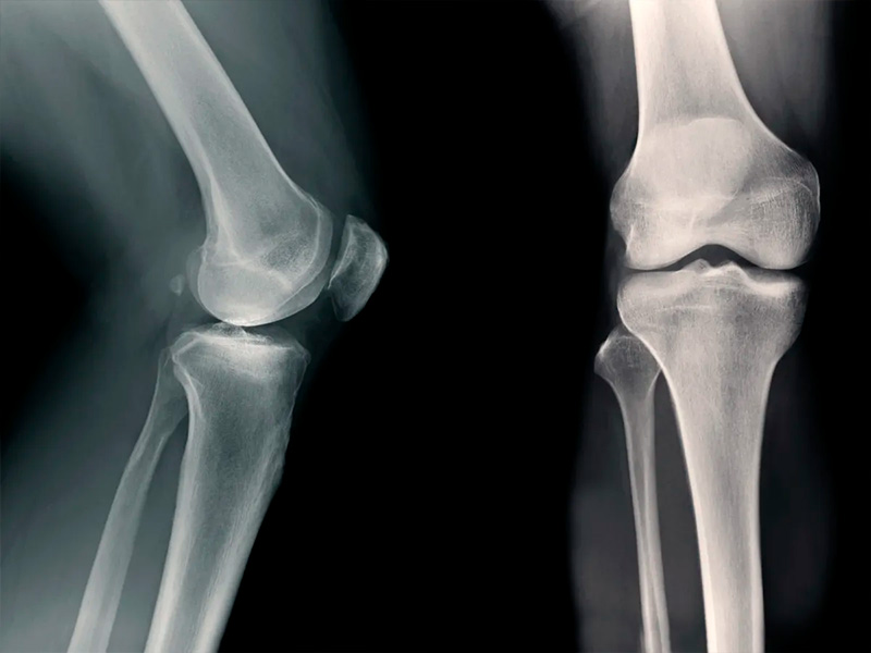 AOD-9604 and osteoarthritis: what modern experimental studies show