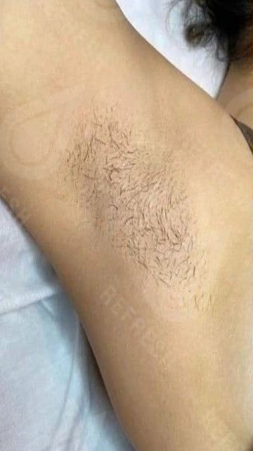 Laser hair removal with Candela GentleMax Pro