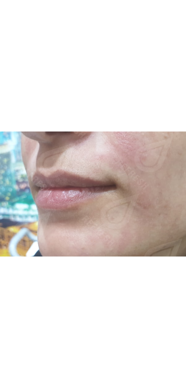 Facial Contouring with Dermal Fillers