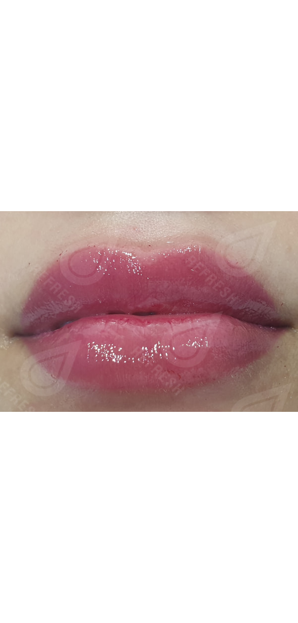 Facial Contouring with Dermal Fillers