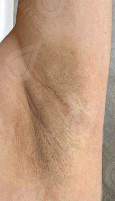 Laser hair removal with Candela GentleMax Pro