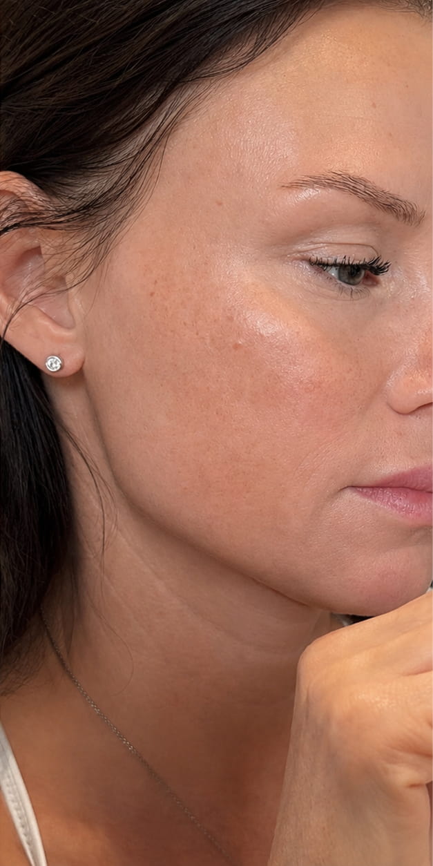 Botulinum Toxin Treatment
