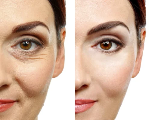 Full-Face Microtoxin Therapy или классический ботулотоксин — что выбрать для максимально естественного результата