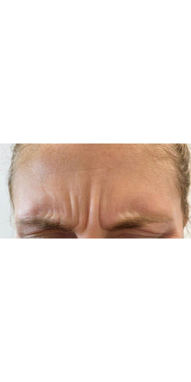 Botulinum Toxin Treatment