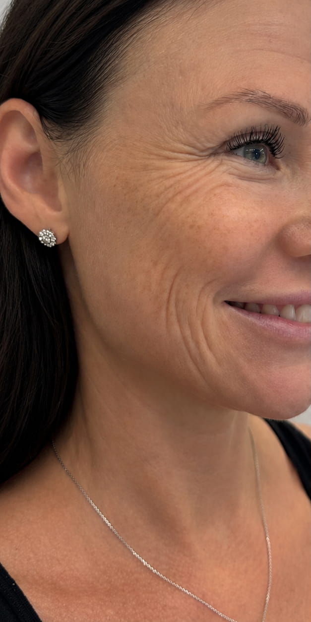 Botulinum Toxin Treatment
