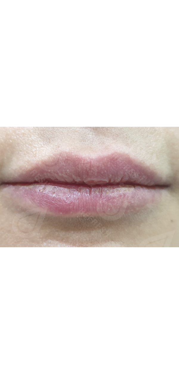 Facial Contouring with Dermal Fillers