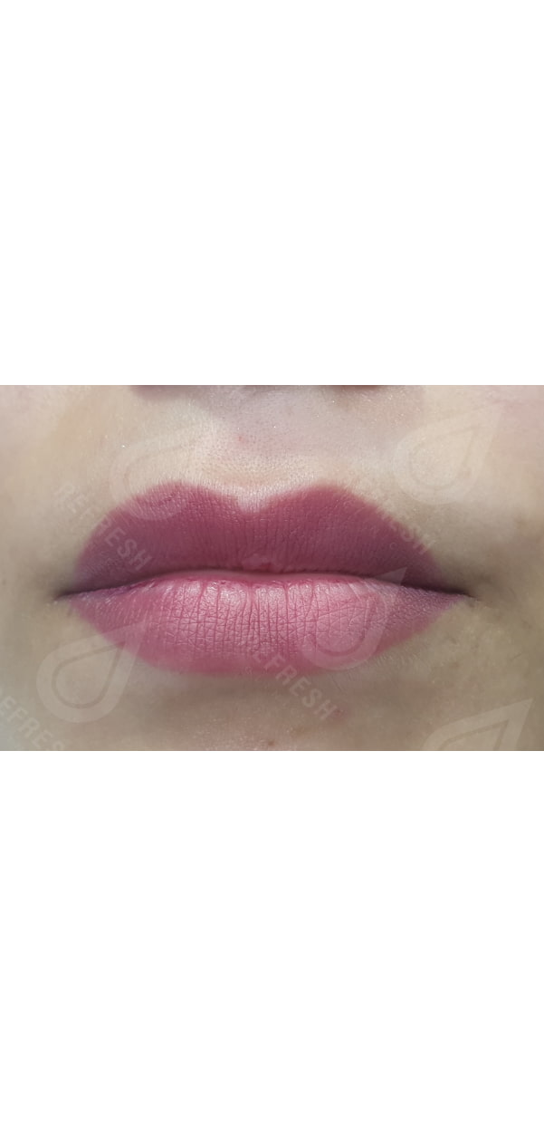 Facial Contouring with Dermal Fillers