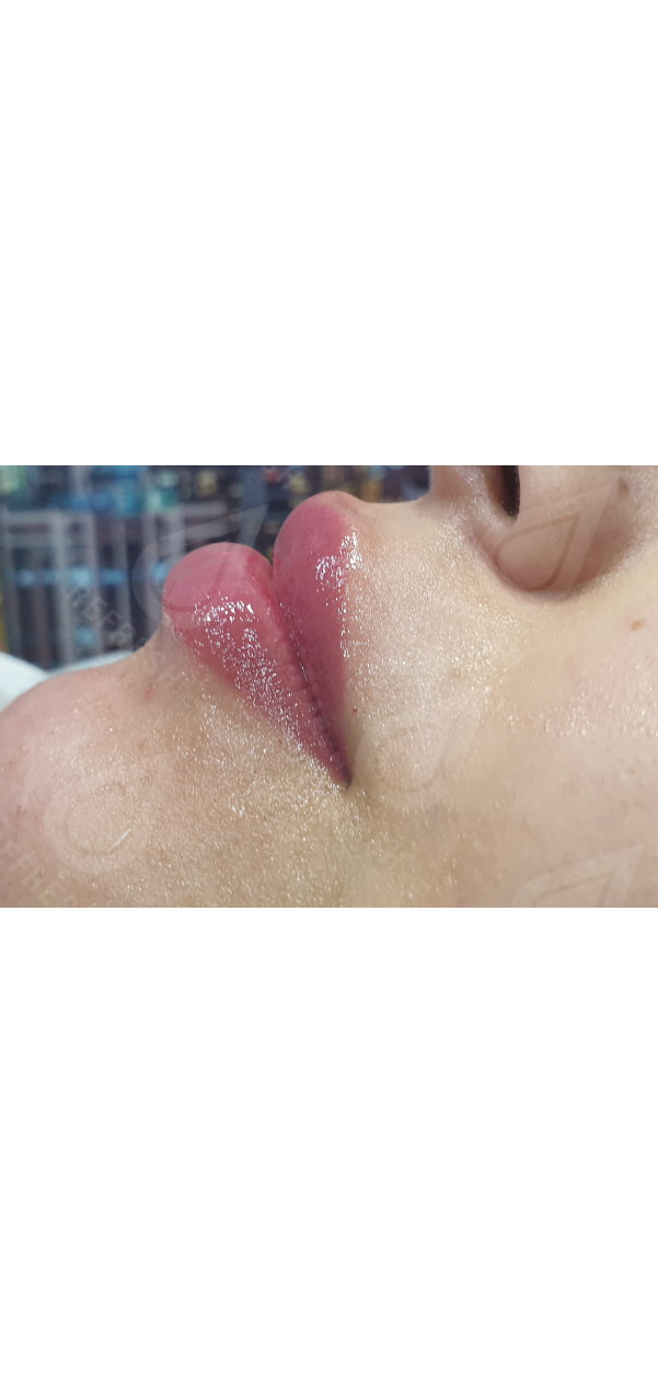 Facial Contouring with Dermal Fillers